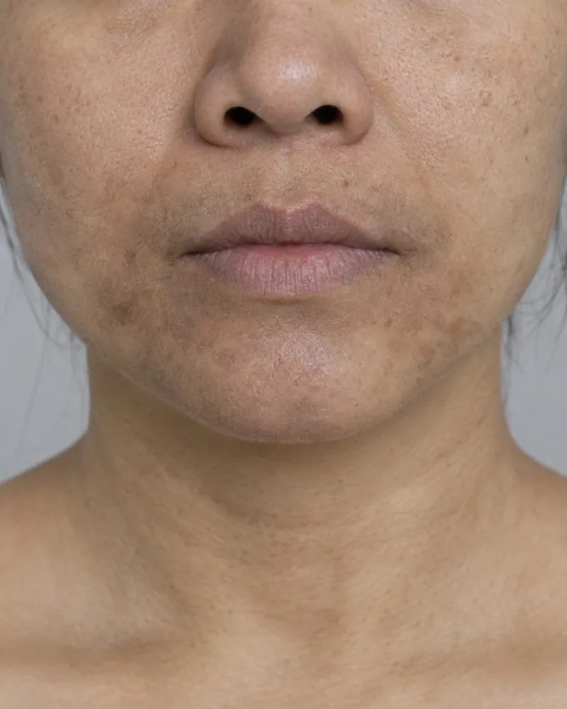Client skin before InstaGlow treatment — dull and uneven complexion